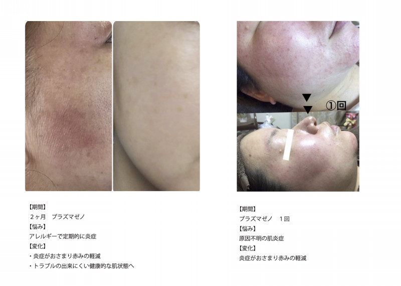 肌再生メソッド】プラズマゼノデュアル＆再生医療発想のハイグレード