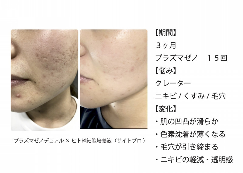 フラッシュプラズマ　ニキビ/レモンボトル/リジュラン　殺菌/導入 フラッシュプラズマ ニキビ/レモンボトル/リジュラン 殺菌/導入｜Yahoo