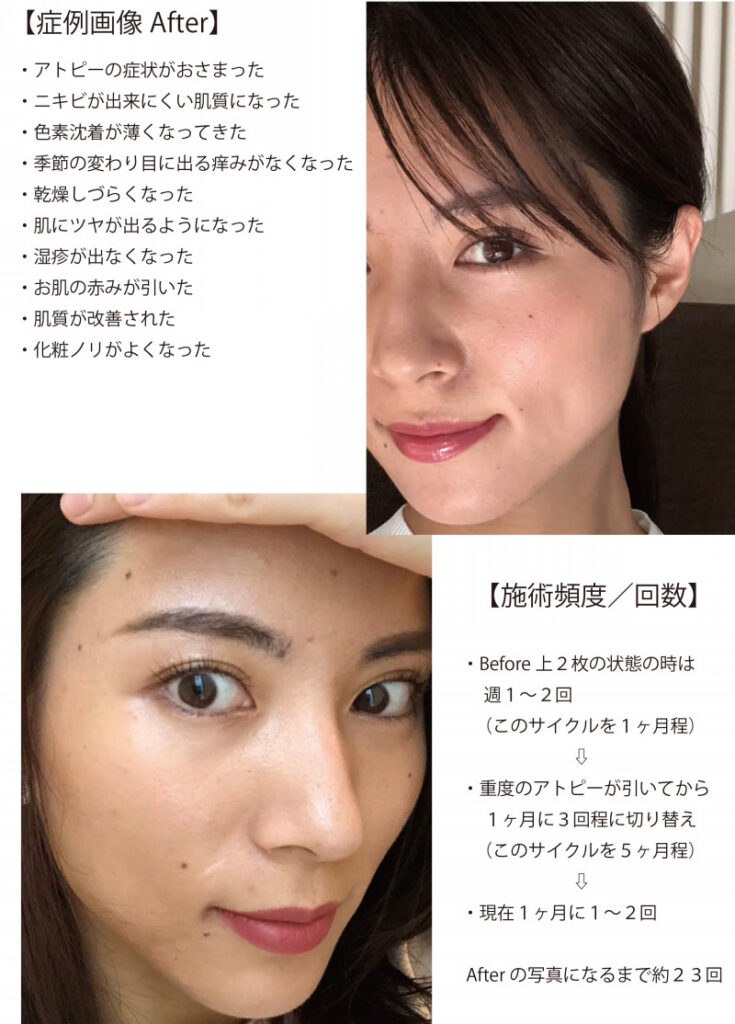 フラッシュプラズマ　ニキビ/レモンボトル/リジュラン　殺菌/導入 フラッシュプラズマ◇オゾンプラズマ ニキビ/レモンボトル/リジュラン