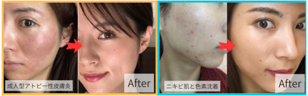 フラッシュプラズマ　ニキビ/レモンボトル/リジュラン　殺菌/導入 フラッシュプラズマ ニキビ/レモンボトル/リジュラン 殺菌/導入 新