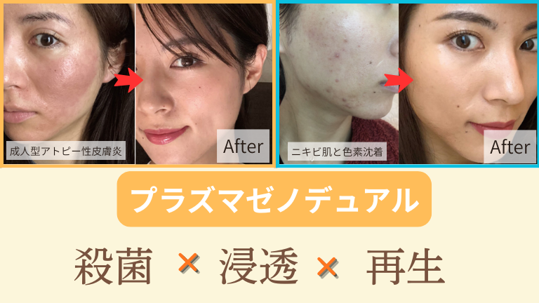 肌再生メソッド】プラズマゼノデュアル＆再生医療発想のハイグレード